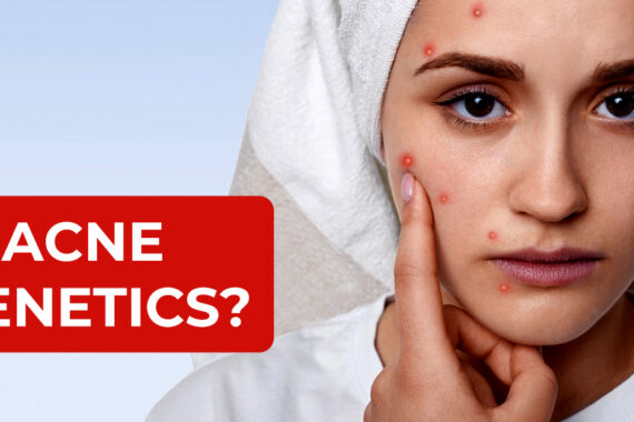 Is Acne Genetics?